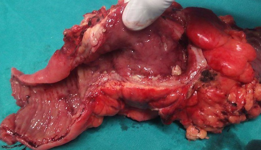 CROHN'S DISEASE