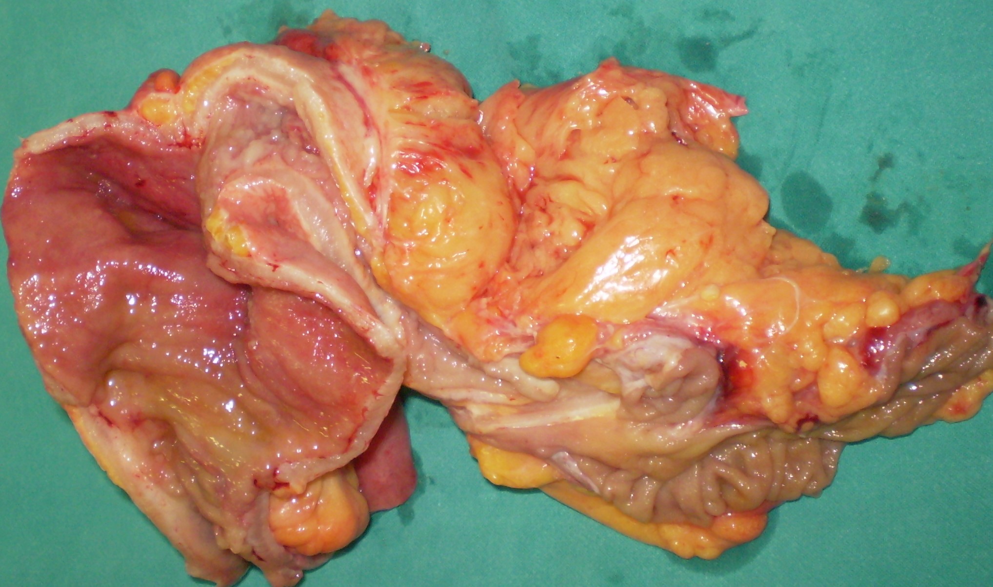CROHN'S DISEASE
