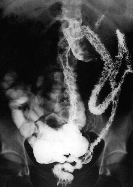 CROHN'S DISEASE