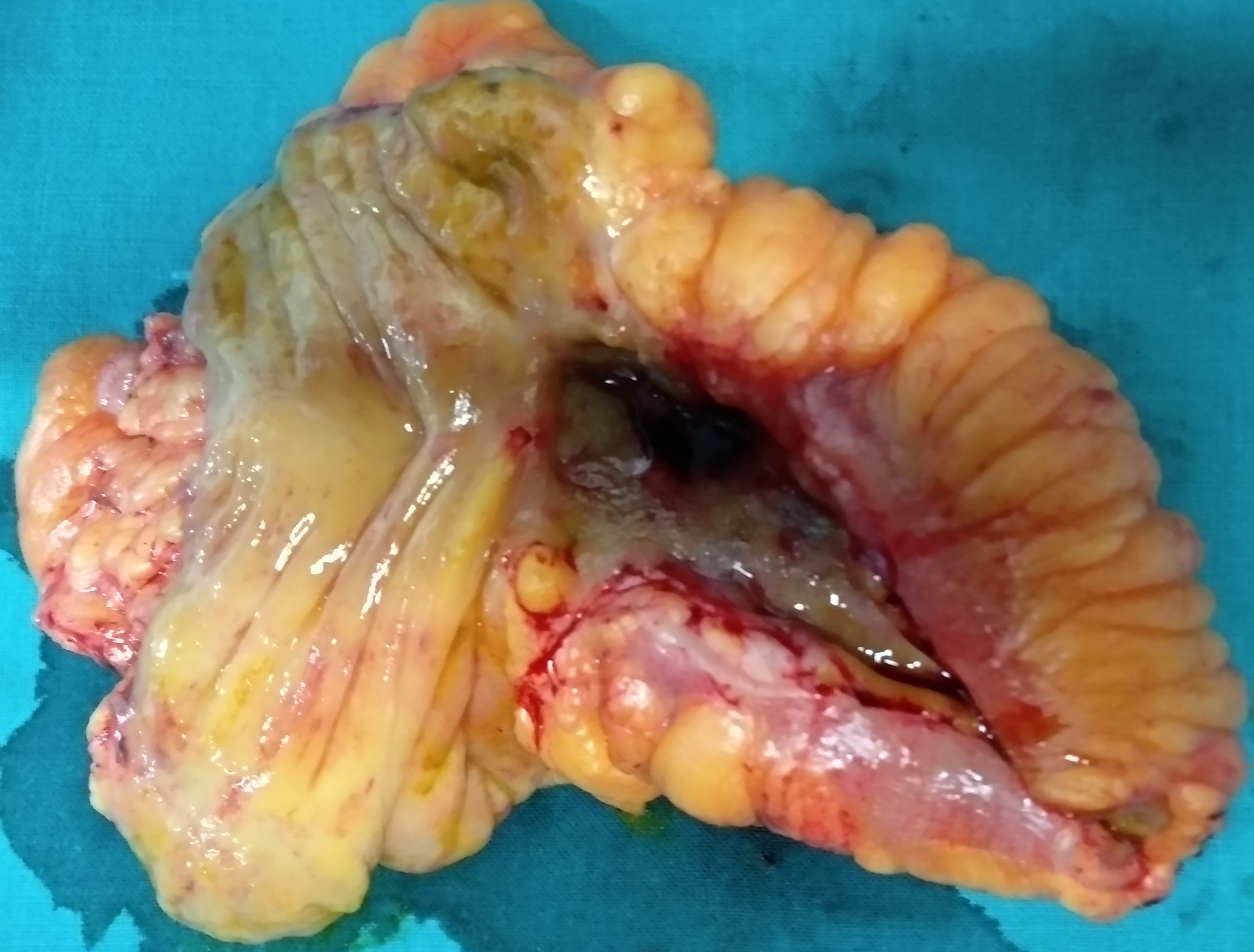 CROHN'S DISEASE