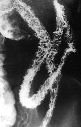 CROHN'S DISEASE