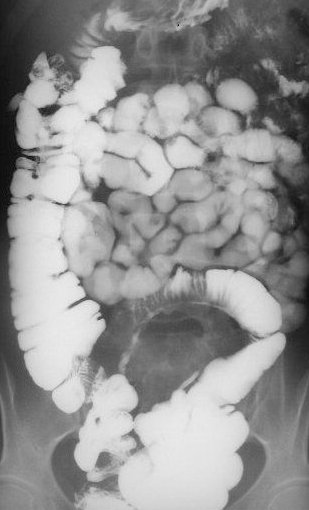CROHN'S DISEASE