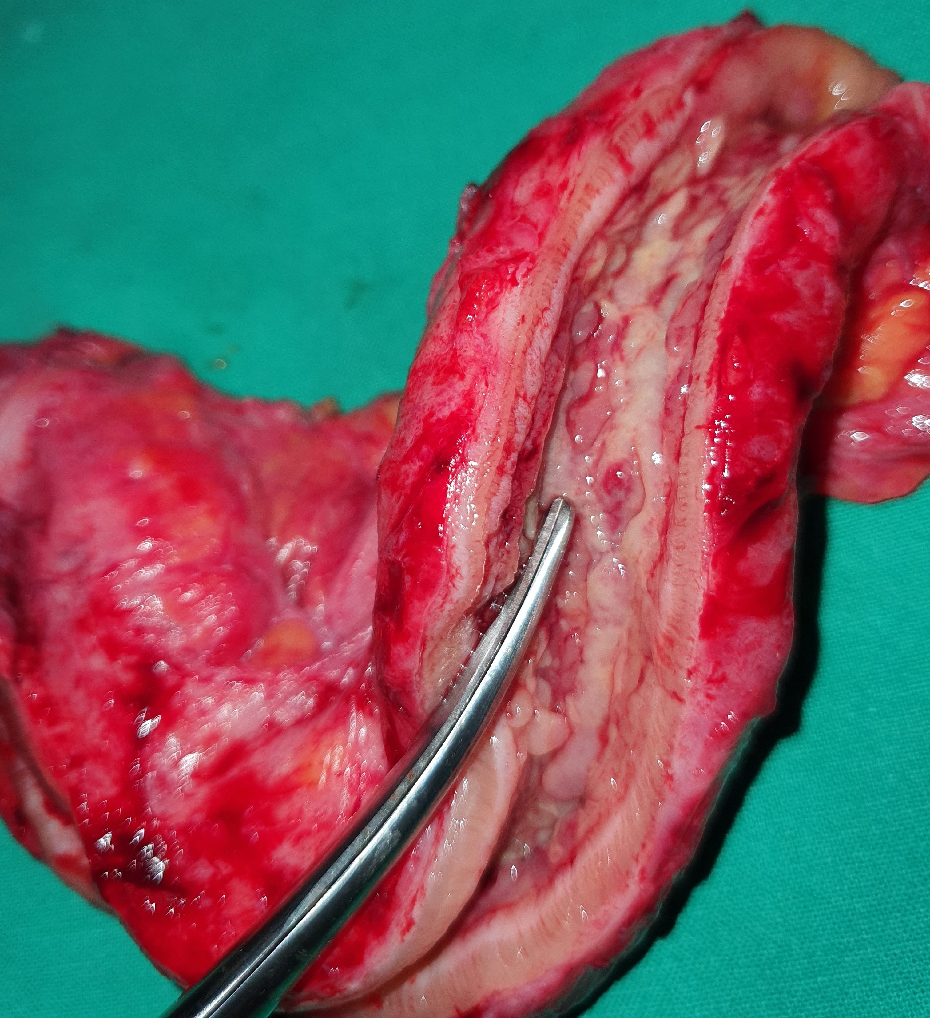 CROHN'S DISEASE