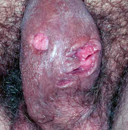 CROHN'S DISEASE - SCROTAL ULCERS