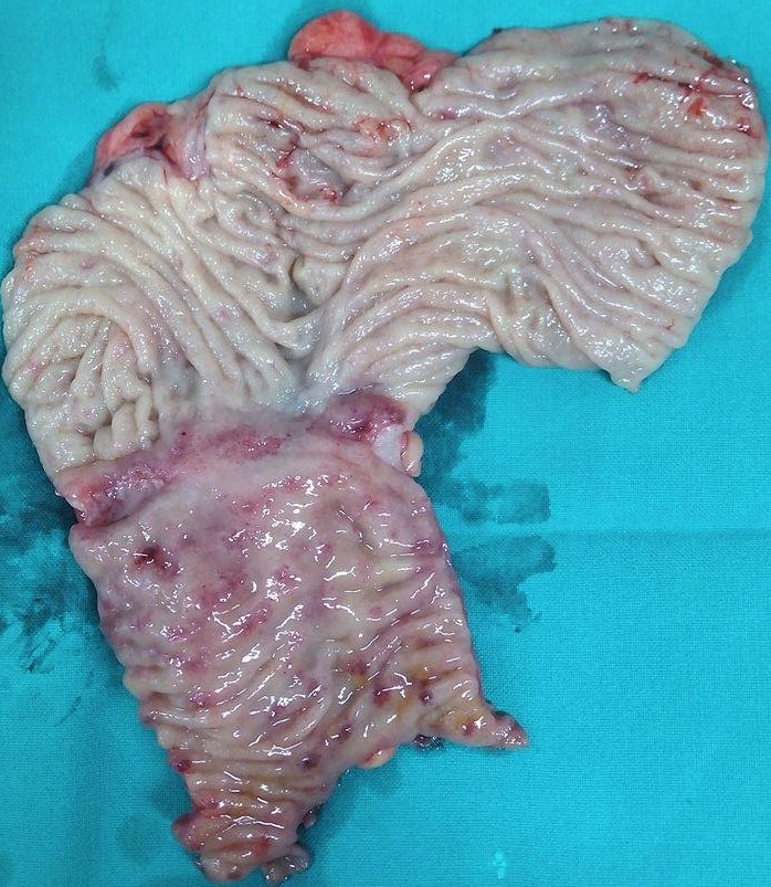 CROHN'S DISEASE  - ENTEROCOLECTOMY