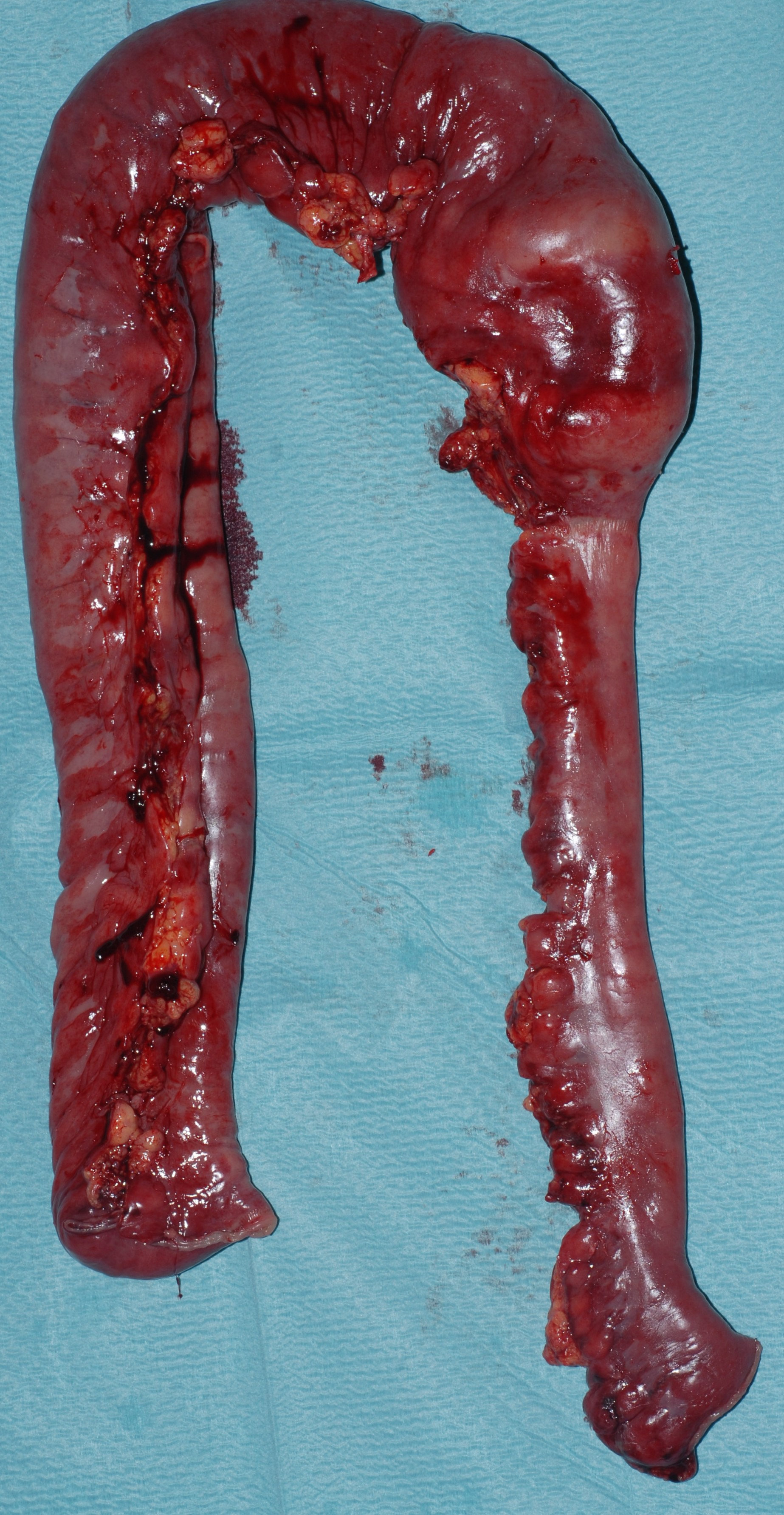 CROHN'S DISEASE -  ENTERECTOMY