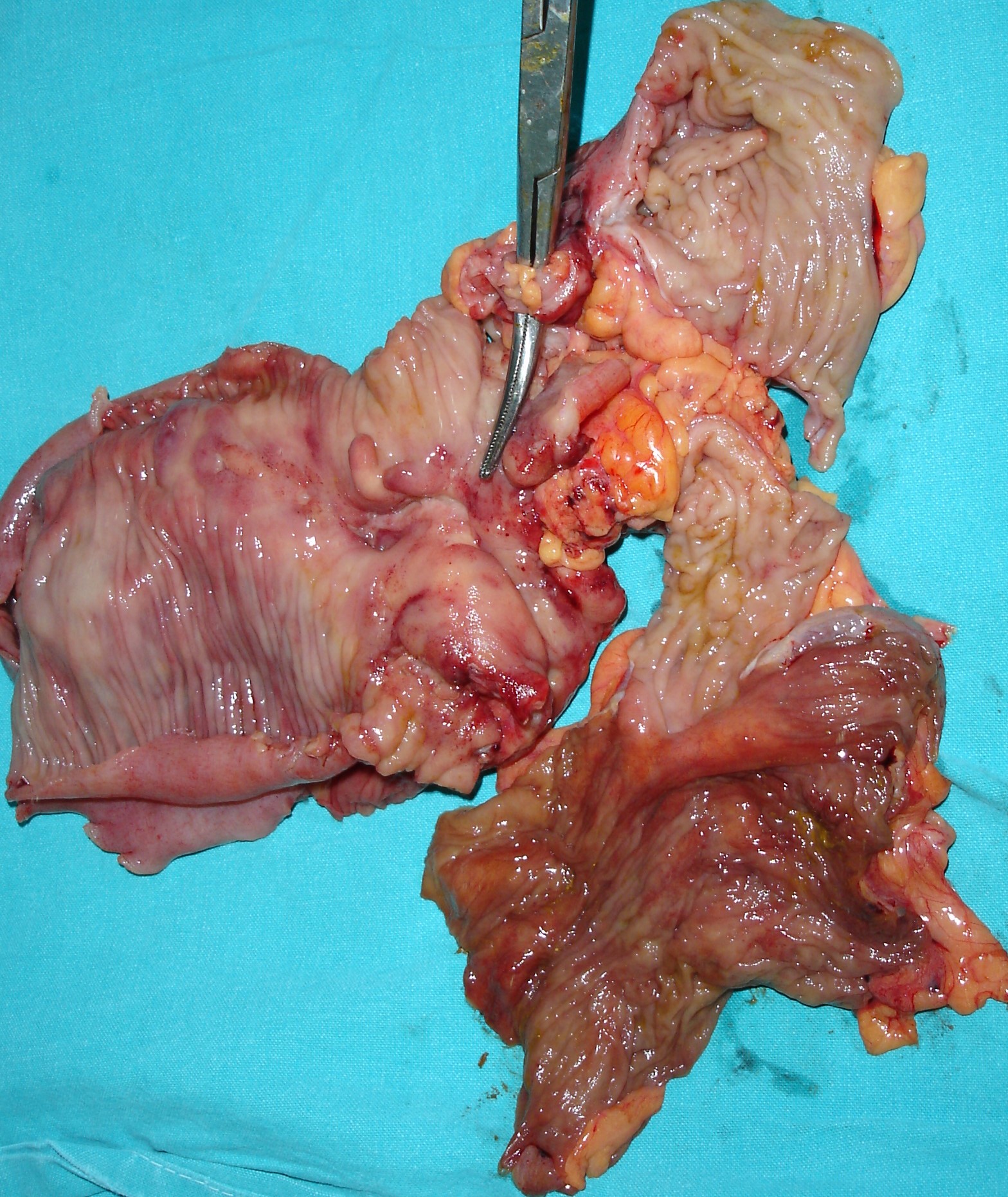 CROHN'S DISEASE - FISTULA