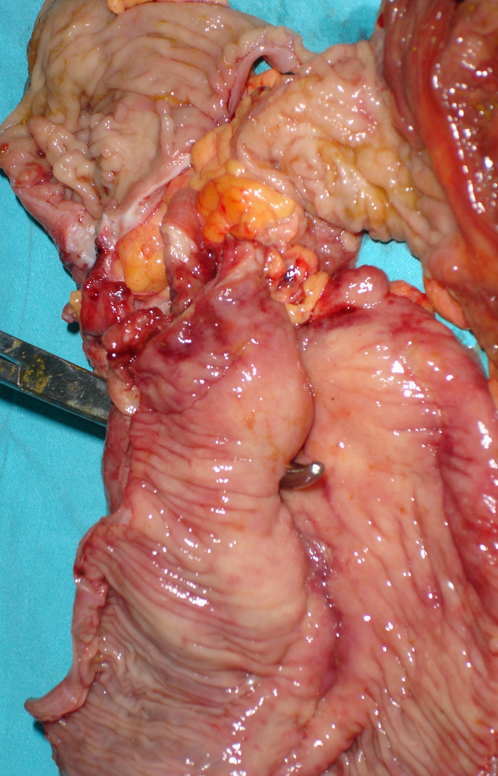 CROHN'S DISEASE - FISTULA 