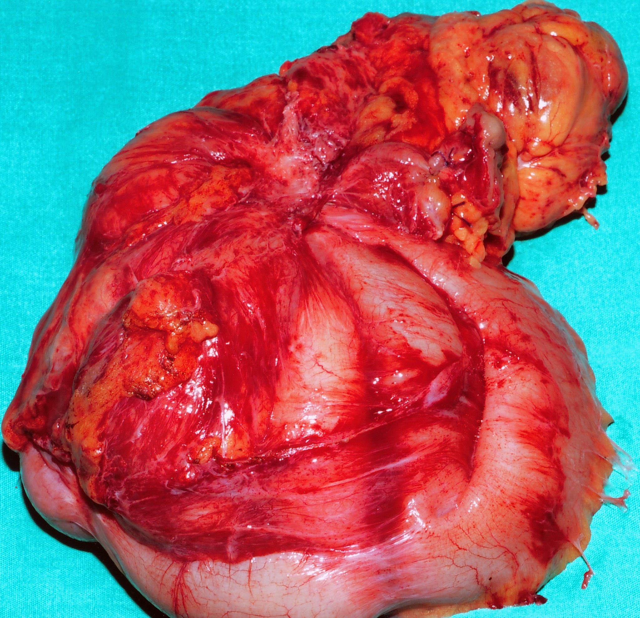 CROHN'S DISEASE - MULTIPLE FISTULAE
