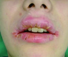 CROHN'S GRANULOMATOSIS