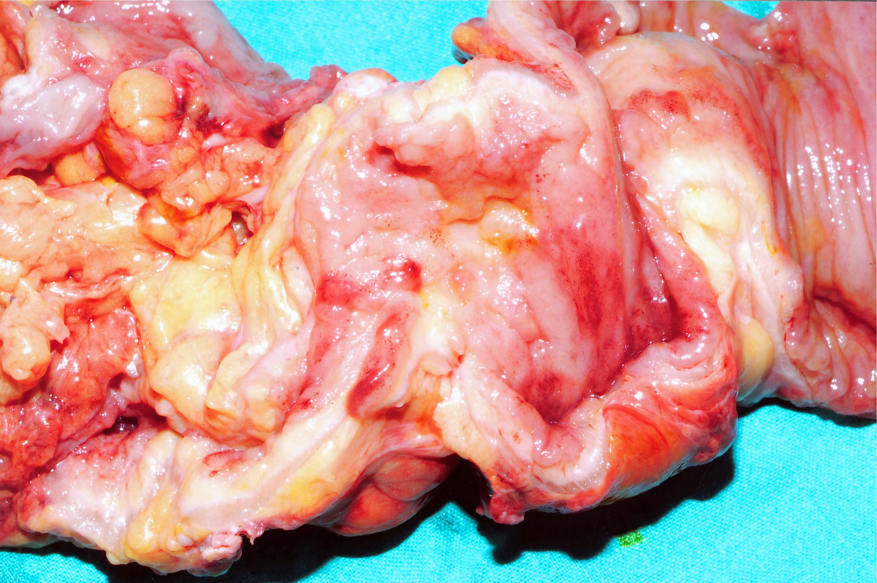 CROHN'S DISEASE - MULTIPLE STRICTURES