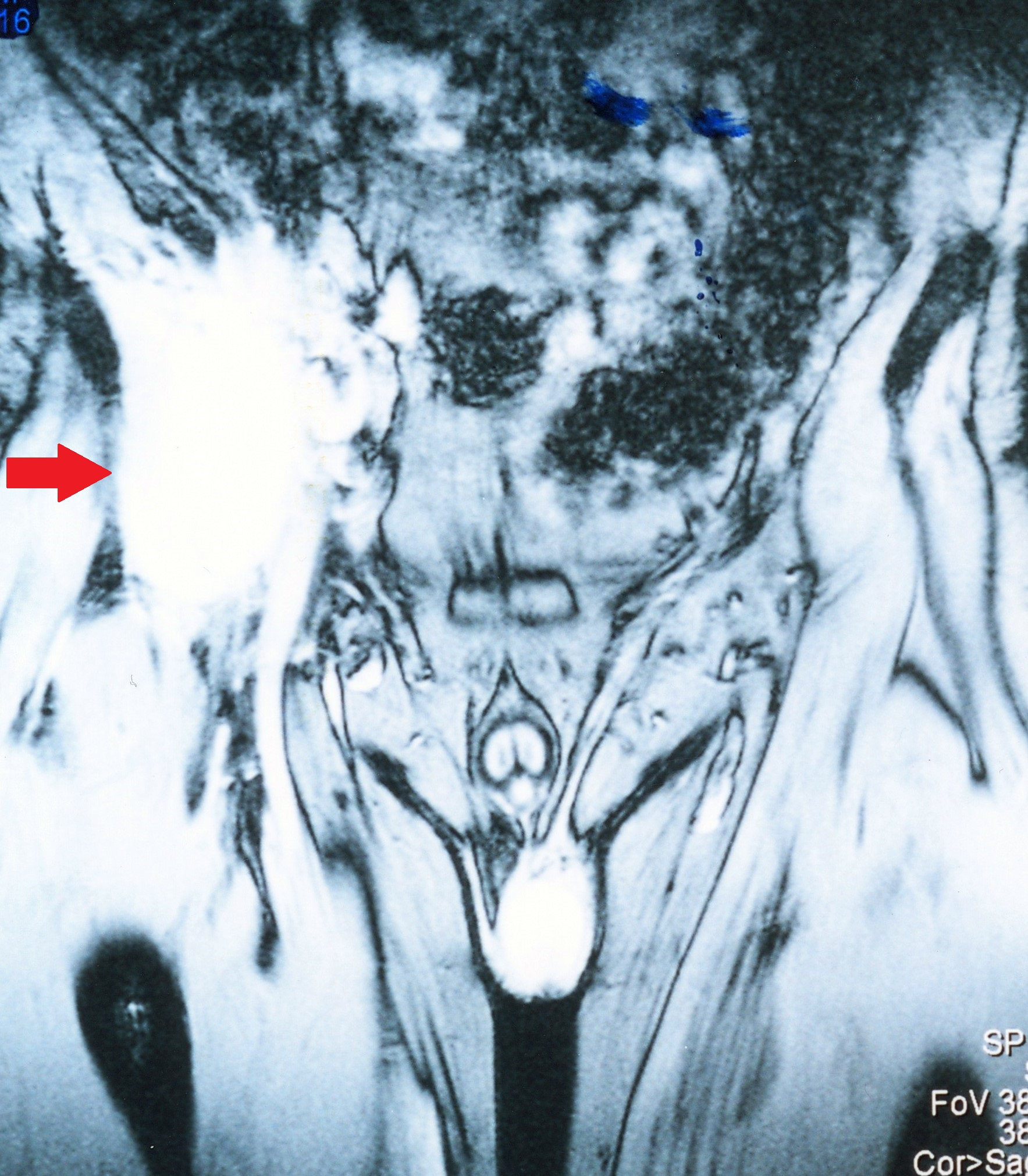 CROHN'S DISEASE - RETROPERITONEAL ABSCESS
