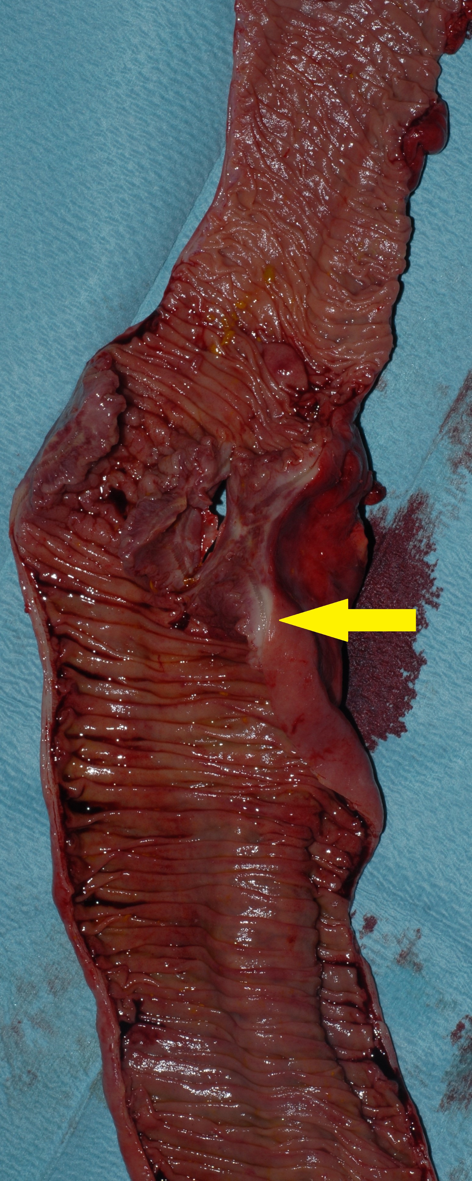 CROHN'S DISEASE - STRICTURE
