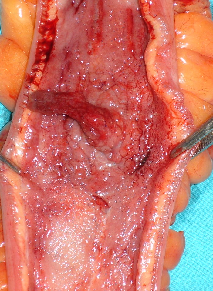 CROHN'S DISEASE