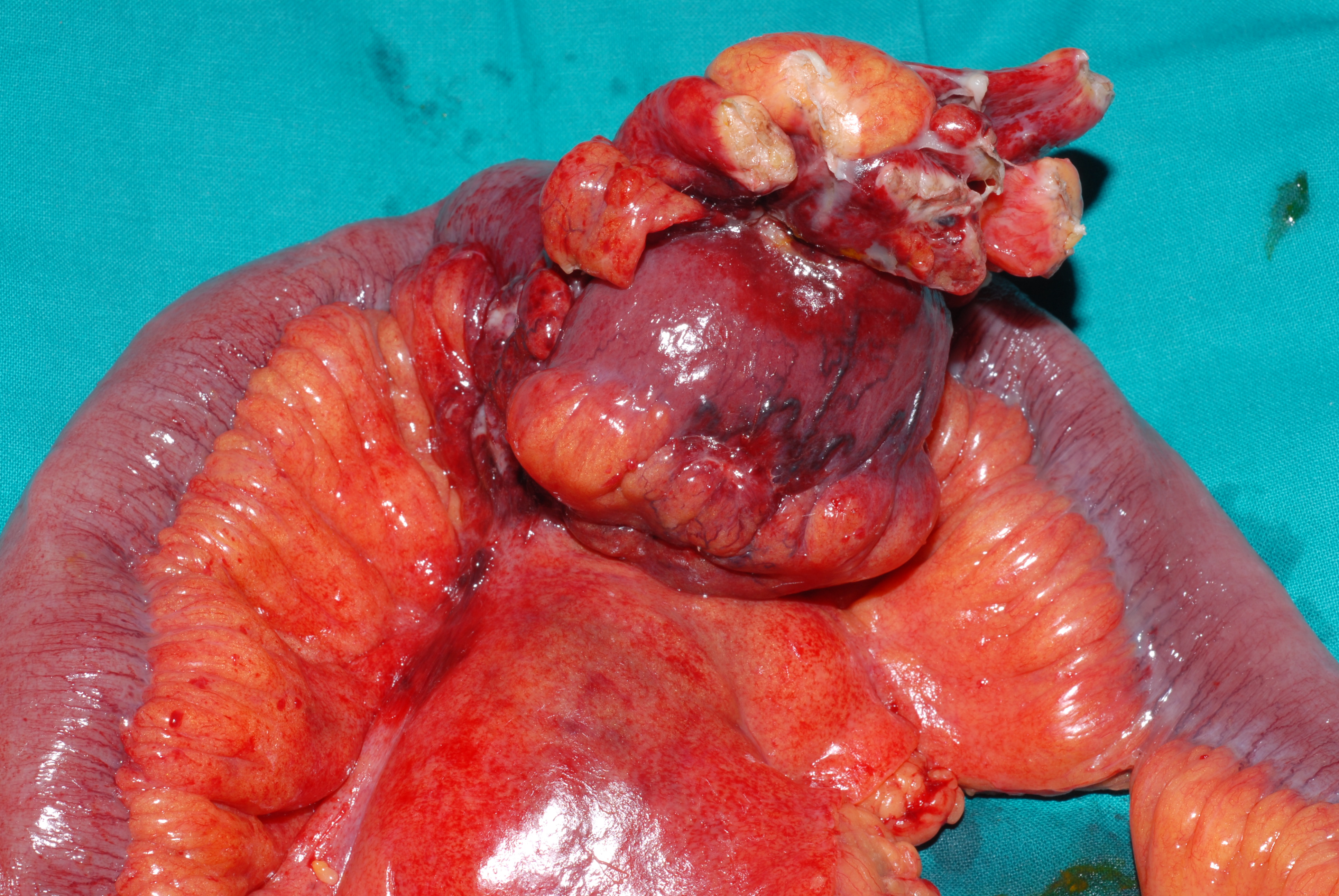 CROHN'S DISEASE