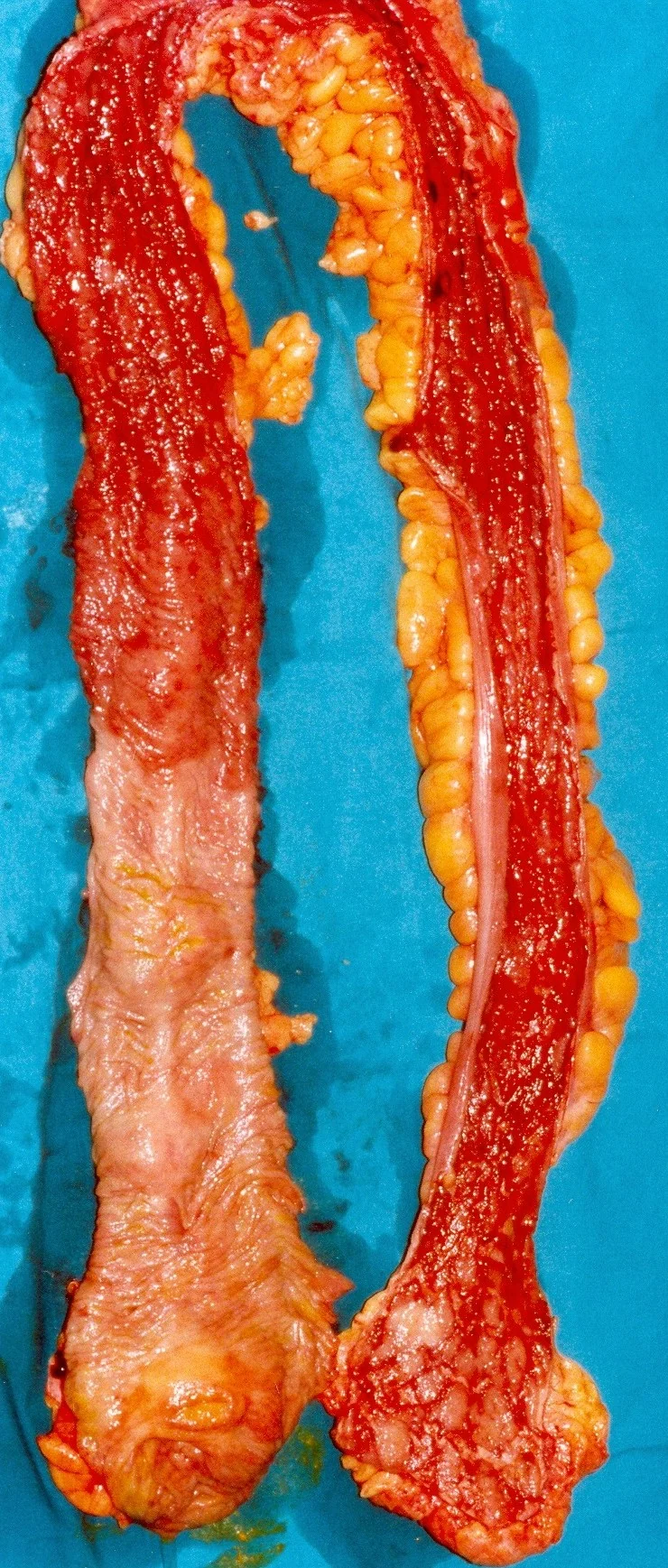ULCERATIVE COLITIS