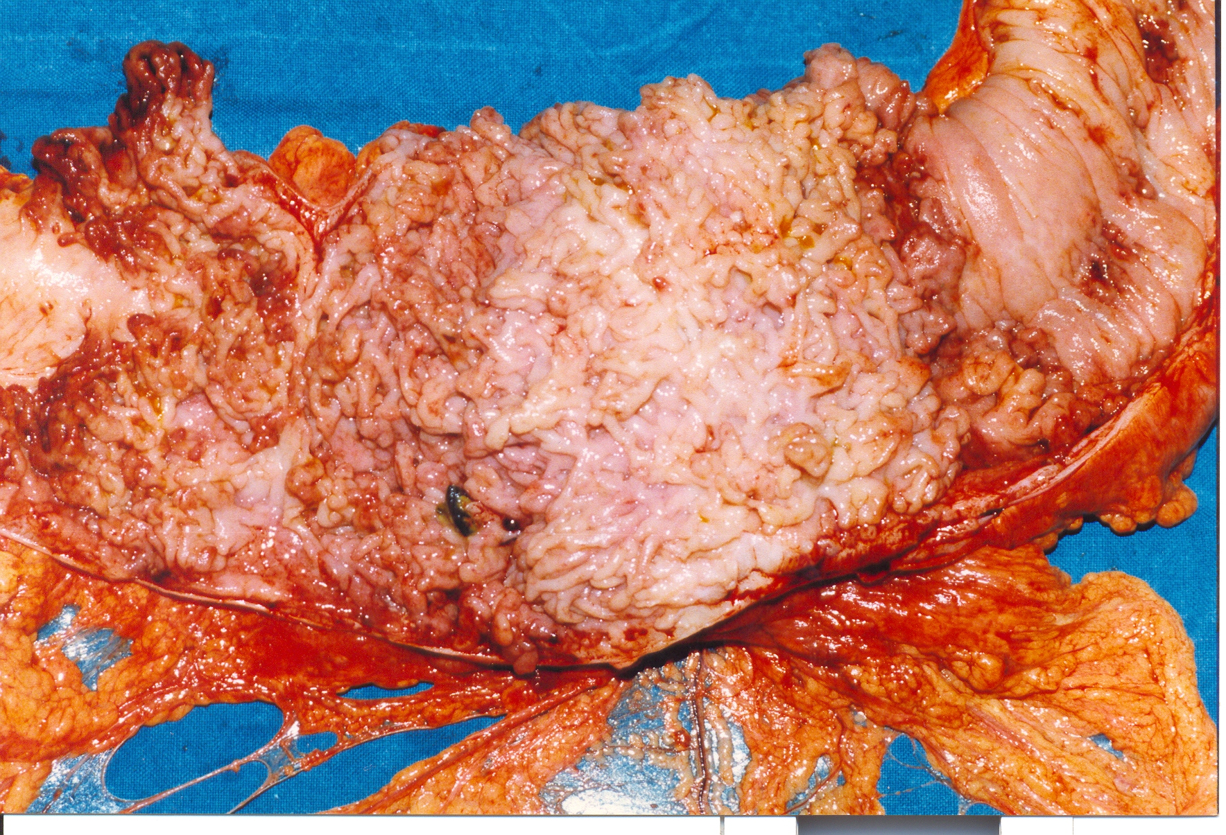 INDETERMINATE COLITIS