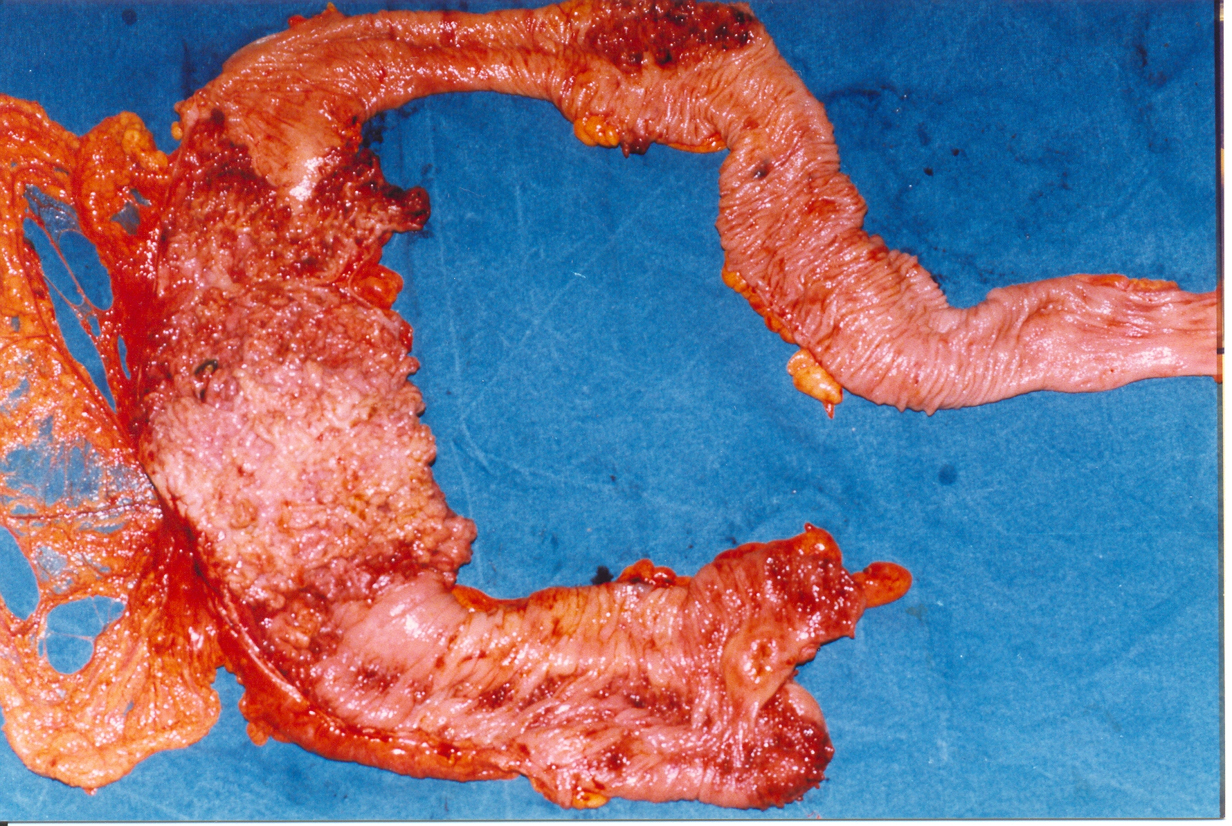 INDETERMINATE COLITIS