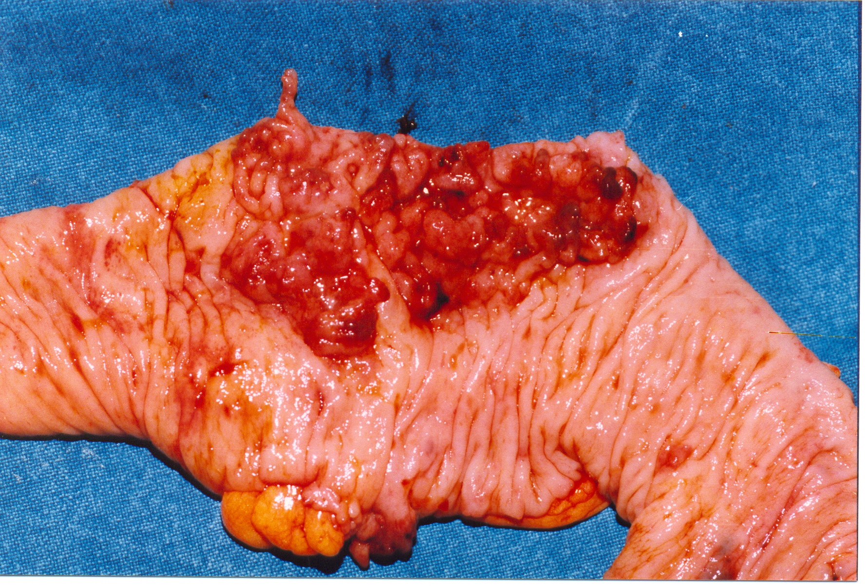 INDETERMINATE COLITIS