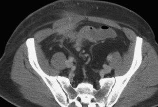 CROHN'S DISEASE - INTESTINAL FISTULA