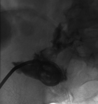 CROHN'S DISEASE - INTESTINAL FISTULA