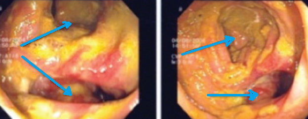 CROHN'S DISEASE - ENTEROCOLIC FISTULA