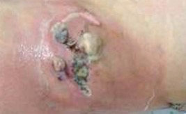 CROHN'S DISEASE - ENTEROCUTANEOUS FISTULA