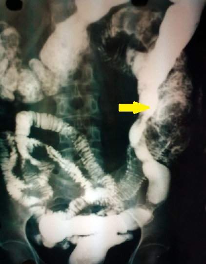 ENTEROLITH - ENTEROCOLIC FISTULA