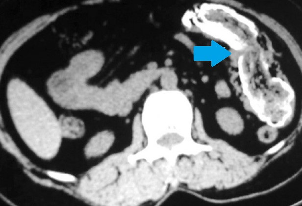 ENTEROLITH - ENTEROCOLIC FISTULA