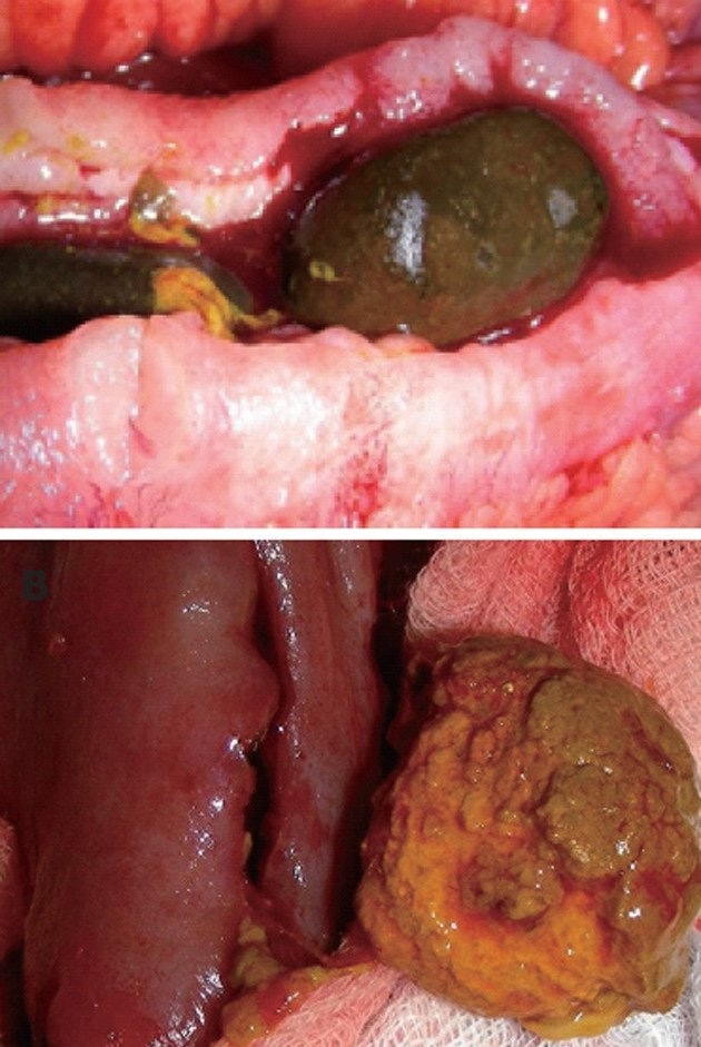 ENTEROLITHS - CROHN'S DISEASE 