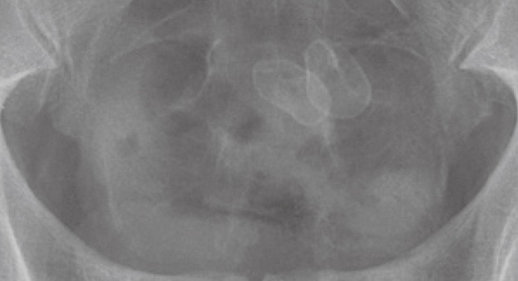 ENTEROLITHS - CROHN'S DISEASE
