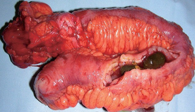 ENTEROLITHS - CROHN'S DISEASE