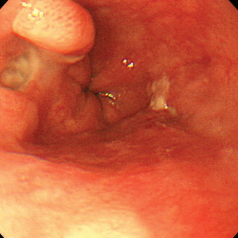 BEHCET'S DISEASE - ESOPHAGEAL ULCERS