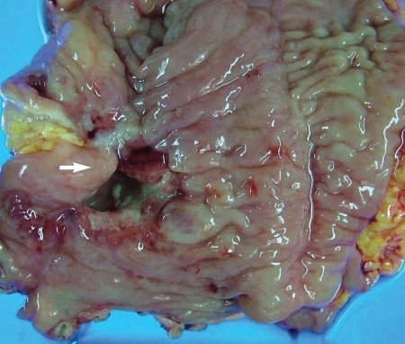 ILEAL POUCH ADENOCARCINOMA 