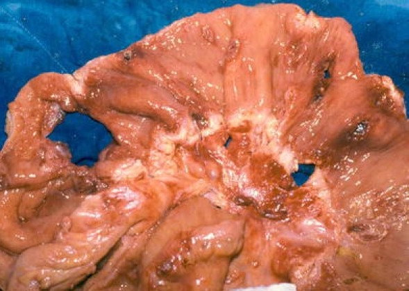 BEHCET'S DISEASE - ILEOCECAL PENETRATING LESIONS