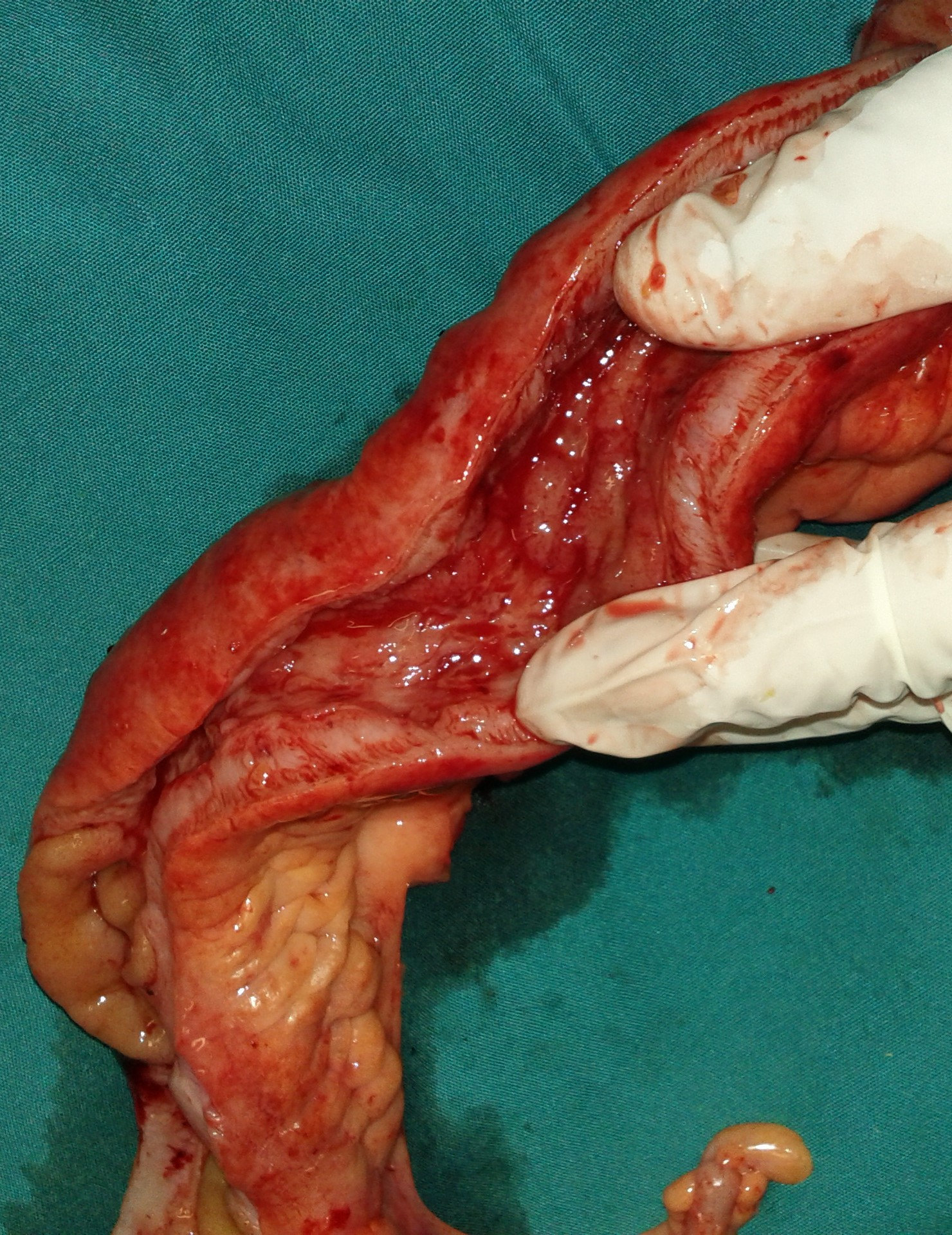 ILEAL STRICTURE