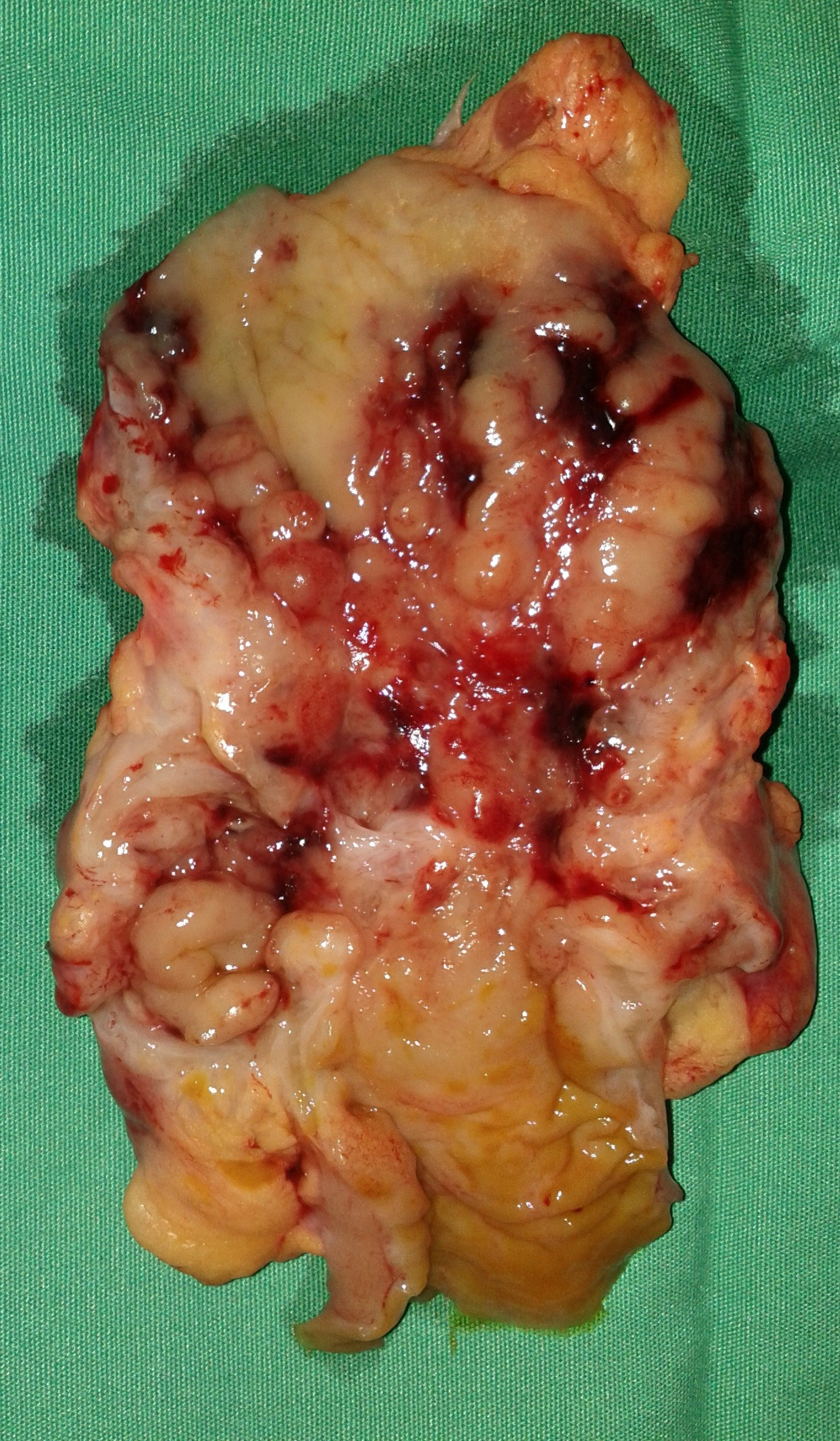 ILEAL STRICTURE