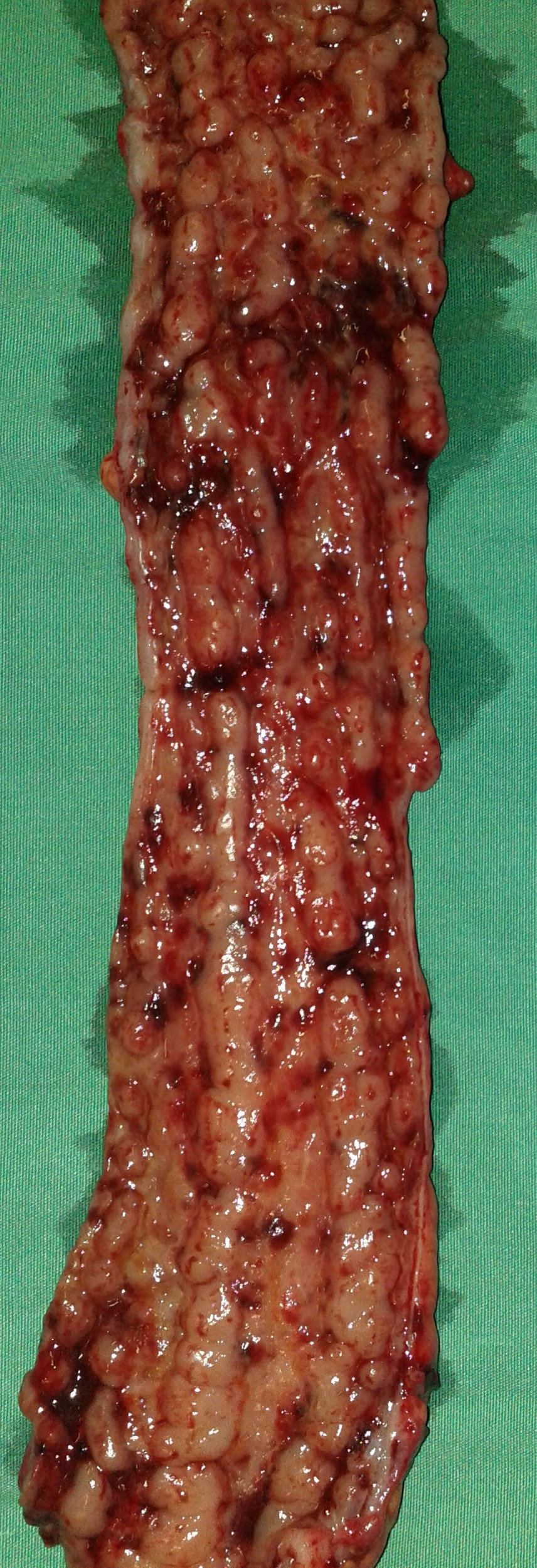 CROHN'S ENTERITIS