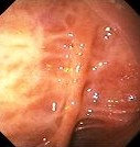CROHN'S FIBROSIS