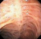 CROHN'S FIBROSIS