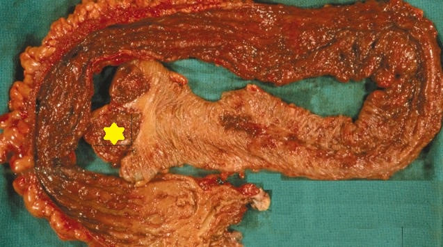 INDETERMINATE COLITIS