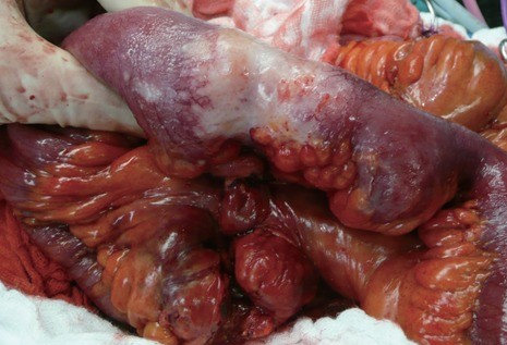 JEJUNAL CROHN'S DISEASE+ADENOCARCINOMA