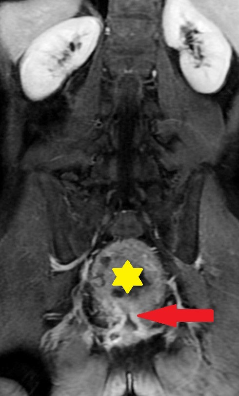 POUCHANAL ANASTOMOSIS STENOSIS