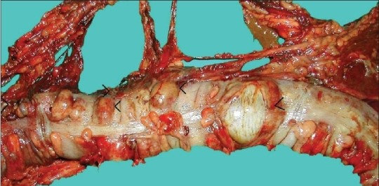 BEHCET'S DISEASE - MULTIPLE PERFORATIONS TRANSVERSE COLON