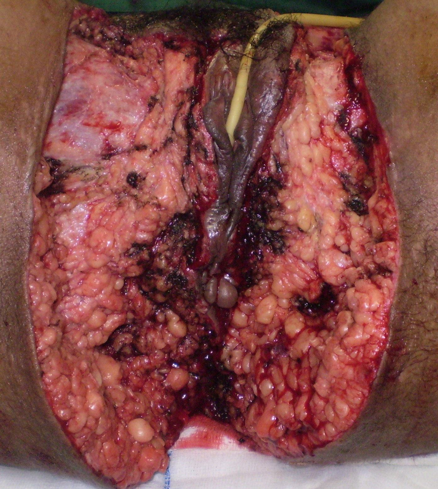 CROHN'S DISEASE - PERIANAL FISTULAE SURGERY