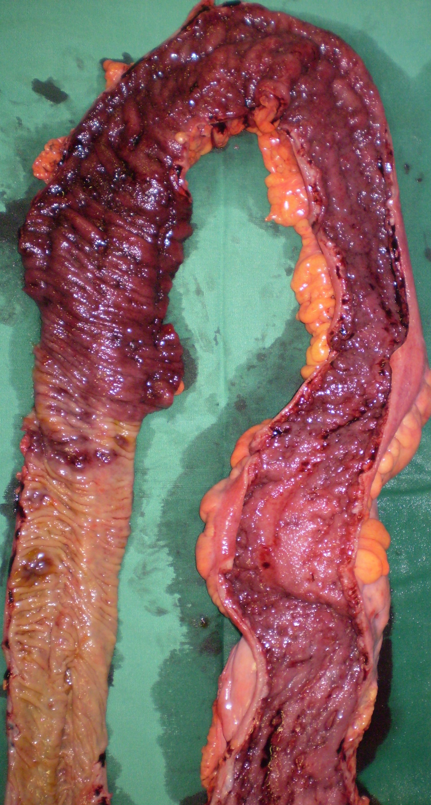 ULCERATIVE COLITIS