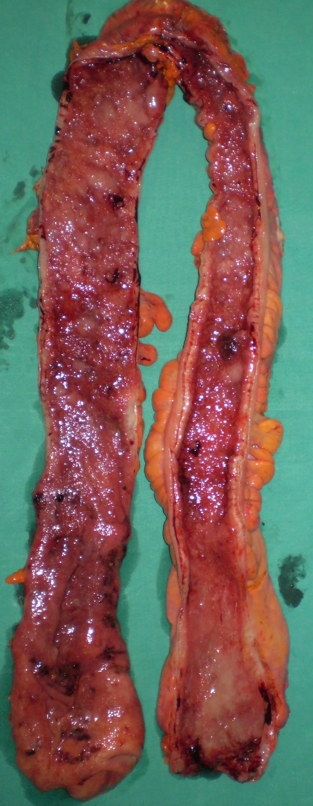 ULCERATIVE COLITIS