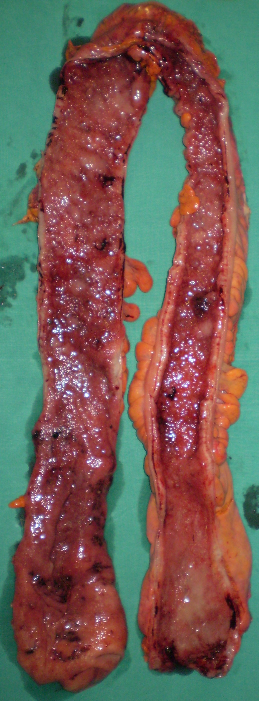 ULCERATIVE COLITIS