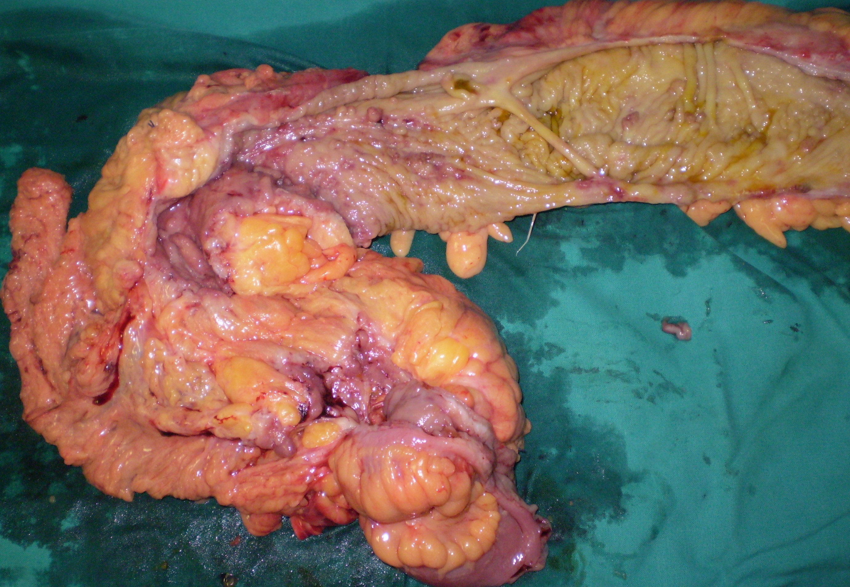 CROHN'S DISEASE