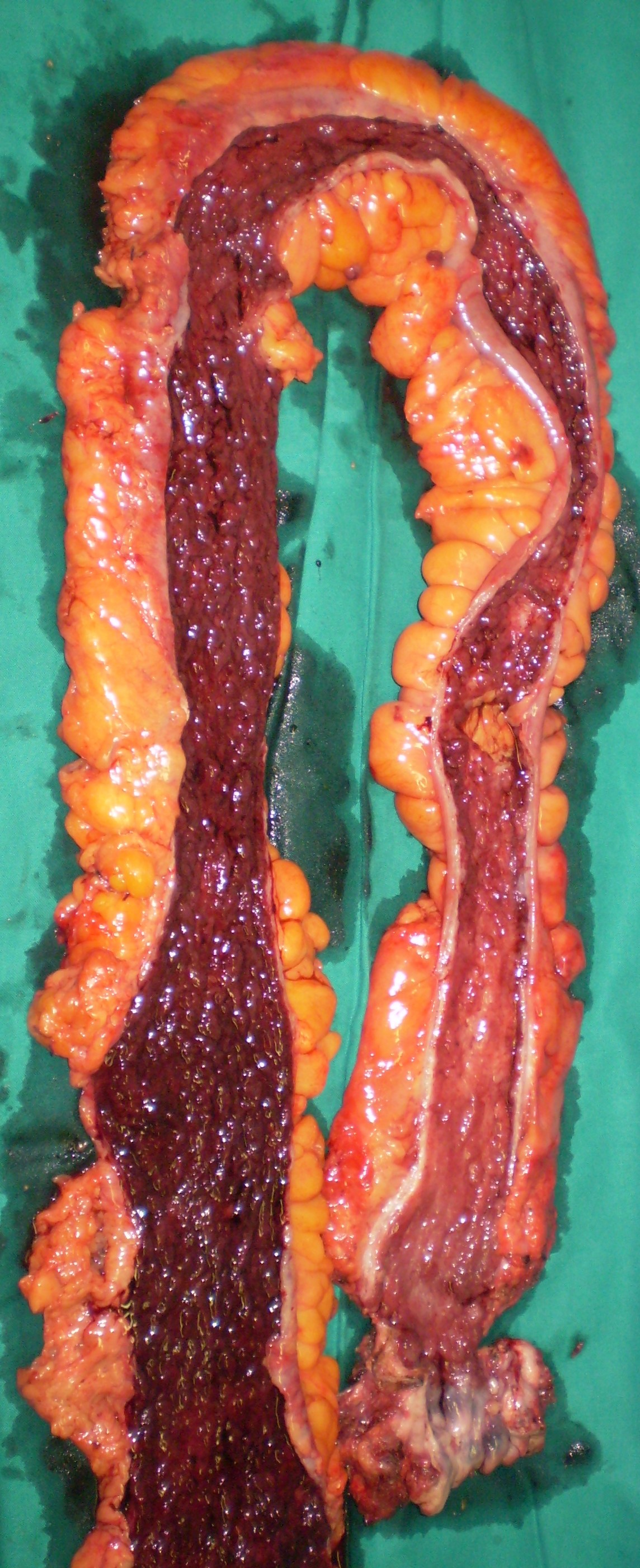 ULCERATIVE COLITIS 